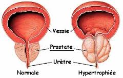 comment soigner la prostate naturellement