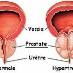 Comment éviter et soigner naturellement l'adénome de la prostate ?